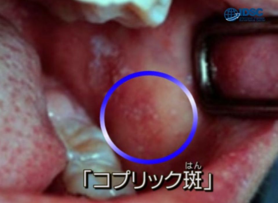 【沖繩麻疹】病情擴散至65人 初步確定有院內感染！